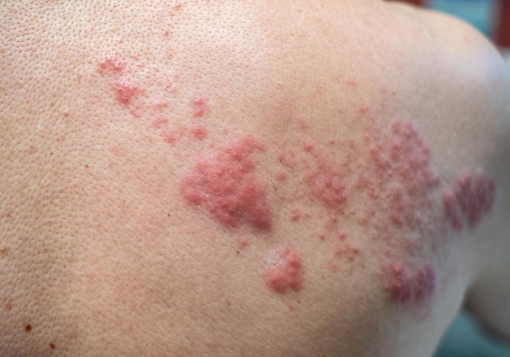 shingles hollinswood