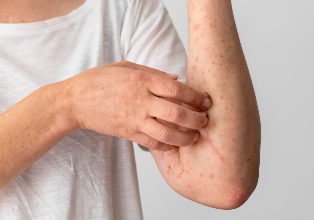 impetigo hollinswood